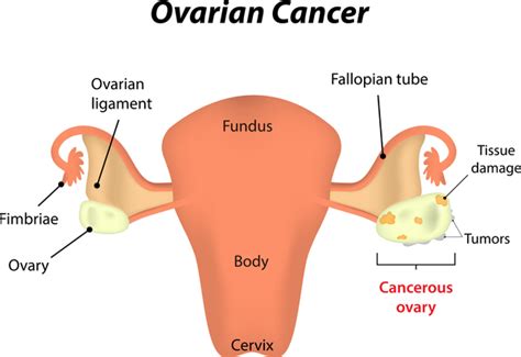 Ovarian cancer   Genetics Home Reference   NIH