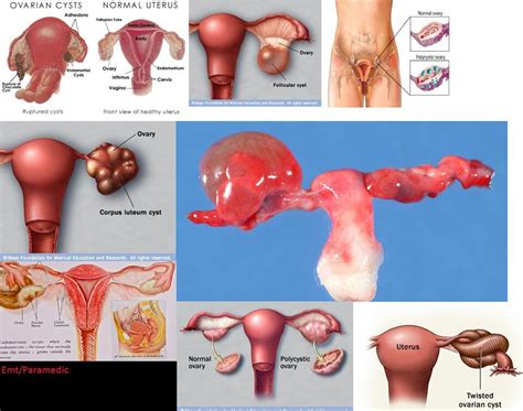 Ovarian cyst is a curse for women. | Endometriosis/PCOS ...