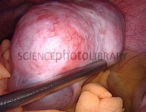 Ovarian cyst, laparoscopy   Stock Image C029/2416 ...