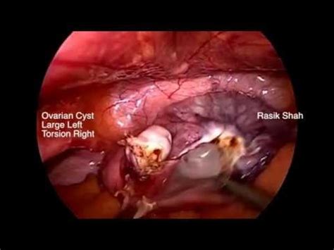 Ovarian Cyst. Large on left side and torsion on right side ...
