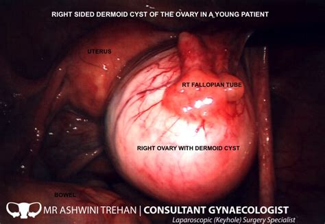 Ovarian Cyst Removal | Laparoscopic  Keyhole  Surgery ...