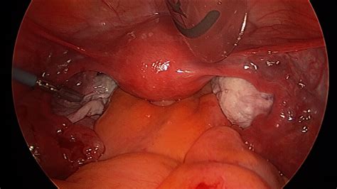 Ovarian Cystectomy Laparoscopic