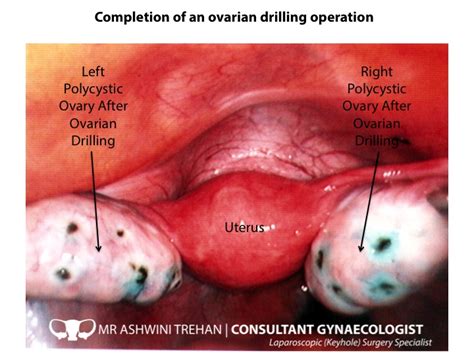 Ovarian Drilling for PCOS | Laparoscopic  Keyhole  Surgery ...