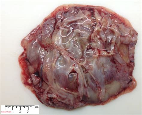 ovarian mucinous cystadenoma   Humpath.com   Human pathology
