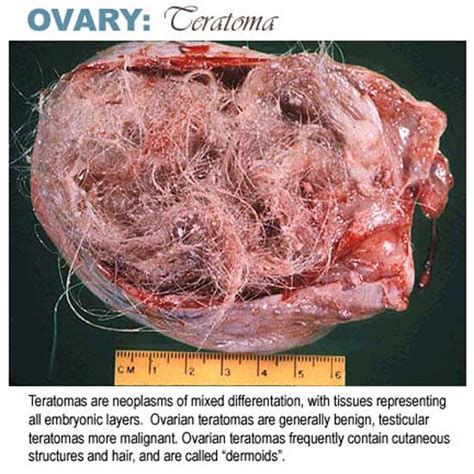 Ovarian Teratoma e.g, hair, teeth, w/e growing in ovaries ...