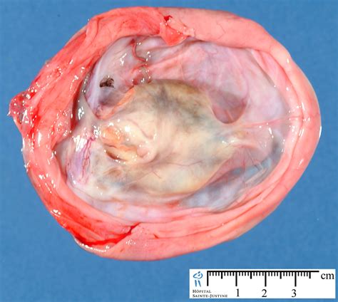 ovarian teratoma   Humpath.com   Human pathology