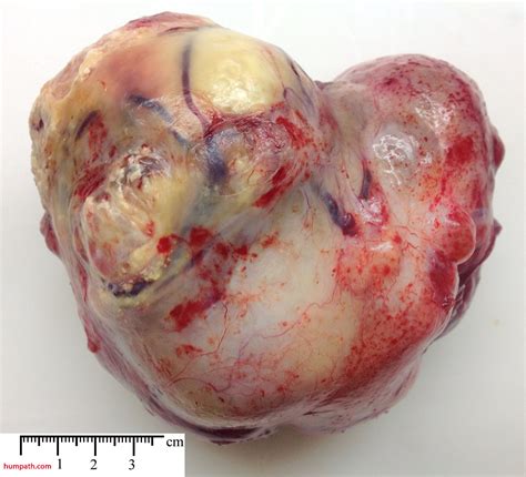 ovarian tumors   Humpath.com   Human pathology