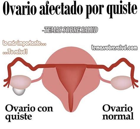 Ovario poliquístico: Causa y no los síntomas