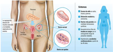 Ovario poliquístico: síntomas y tratamiento Canal Salud ...