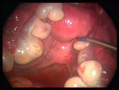 Ovarios Poliquísticos: Síntomas y tratamiento