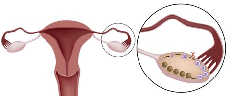 Ovarios poliquísticos: Síntomas y tratamientos