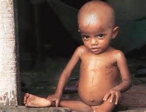 Over a third of Delhi children malnourished, reveals ...