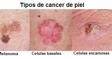 Pacientex: Cancer de piel
