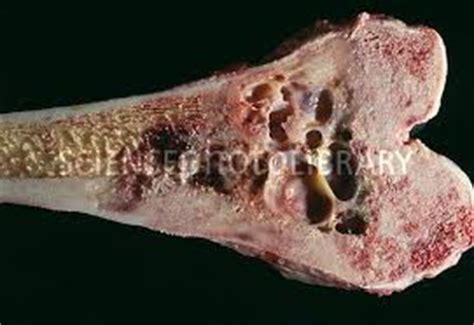 Pagets disease of Bone | Australia| PDF | PPT| Case ...