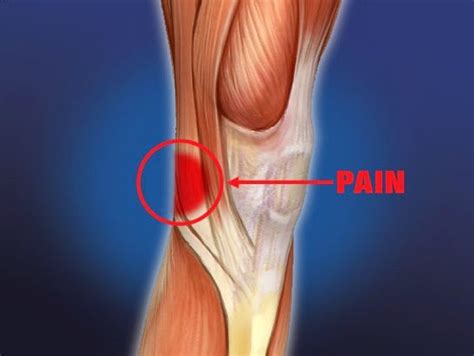 Pain Behind Knee: Causes, Symptoms, Treatment, Home ...