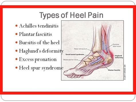 Pain in Heel of Foot | How to Get Rid of Plantar Fasciitis ...