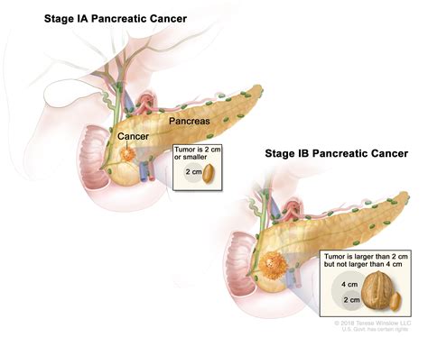 Pancreatic Cancer Treatment PDQ® —Patient Version ...