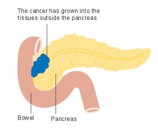 Pancreatic cancer   Wikipedia