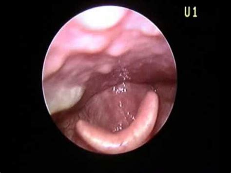 Papilomatosis laringea editado   YouTube