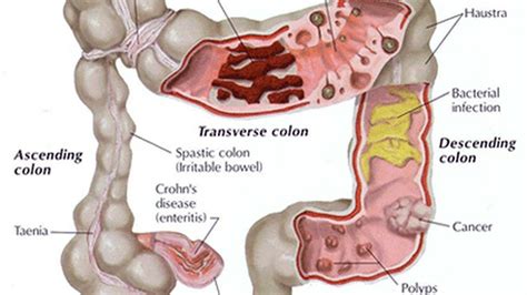 Parasite Colon Cleanse Recipes – Blog Dandk