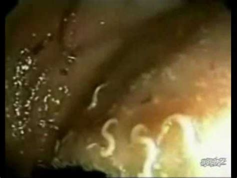 Parasites In Human Stomach   YouTube