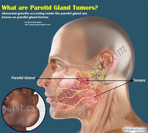 Parotid Gland Tumor|Causes|Symptoms|Treatment|Risk Factors