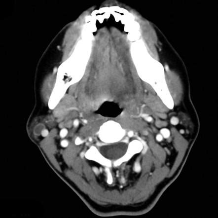 Parotid lymphoepithelial cyst | Image | Radiopaedia.org