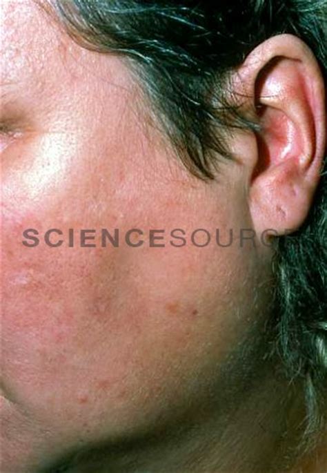 Parotid swelling due to blocked salivary duct | Stock ...