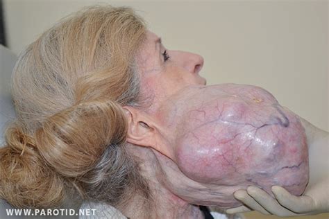Parotid Tumor Surgery Stories and Pictures from Patients