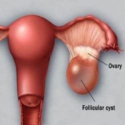 Pathology definition   Ovarian Cyst   Medical Zone