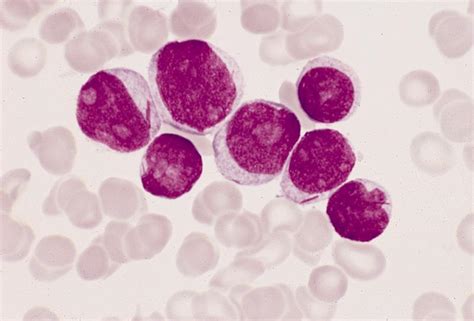 Pathology Outlines   Acute myeloid leukemia without ...