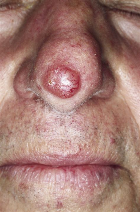 Pathology Outlines   Basal cell carcinoma  BCC