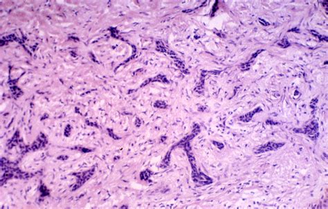 Pathology Outlines   Basal cell carcinoma  BCC