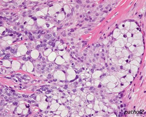 Pathology Outlines   Mucoepidermoid carcinoma