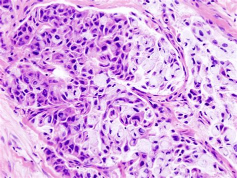 Pathology Outlines   Mucoepidermoid carcinoma