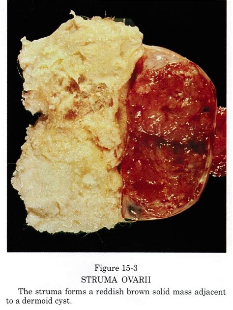 Pathology Outlines   Struma ovarii