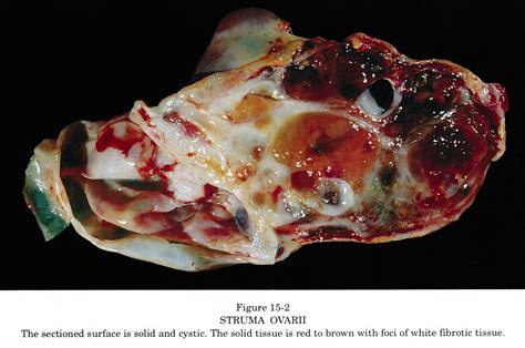 Pathology Outlines   Struma ovarii