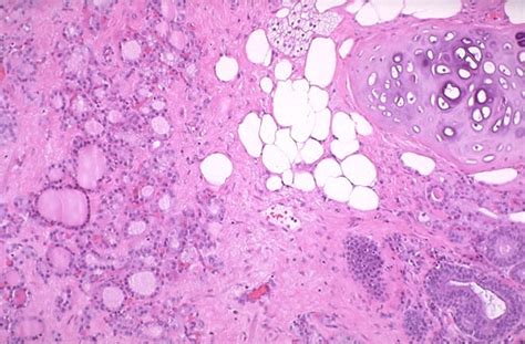 Pathology Outlines   Teratoma mature