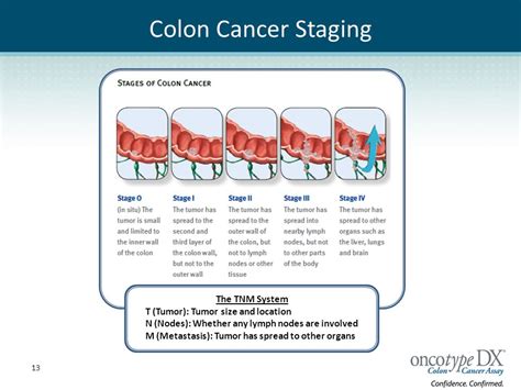 Patient Guide to Colon Cancer Surgery and Treatment   ppt ...