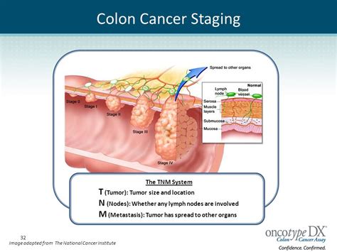 Patient Guide to Colon Cancer Surgery and Treatment   ppt ...