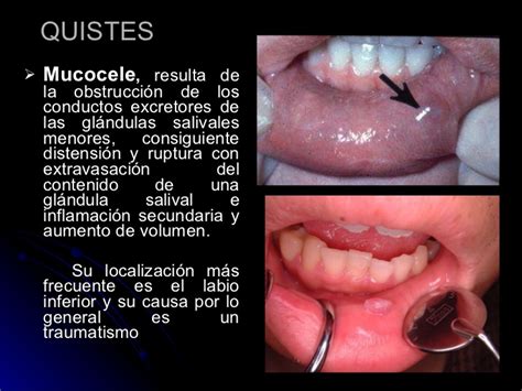 Patologia de las glandulas salivales