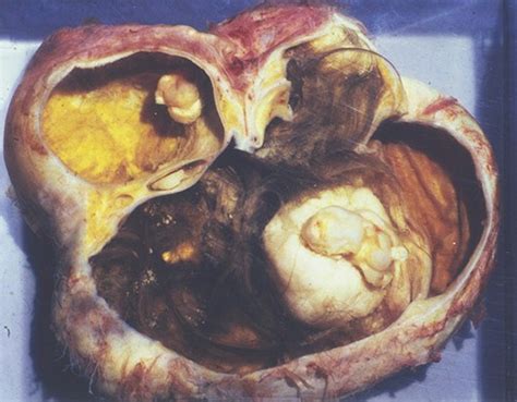 Patologia de los ovarios. Tumores   Revista Electrónica de ...
