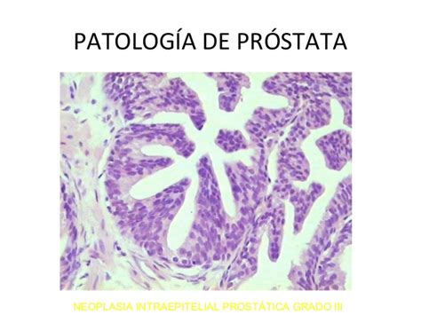 Patología de próstata.