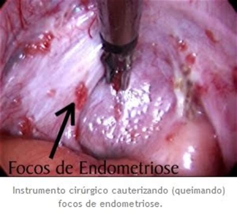 Patologia Urgente: Endometriose....