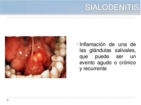Patologias de la cavidad bucal y glandulas salivales UPAO ...