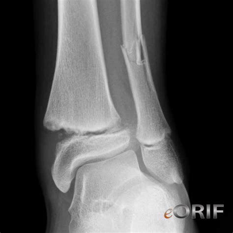 Pediatric Distal Tibial Physeal Fractures S82.209A 823.80 ...