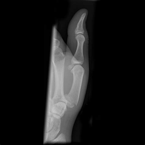 Pediatric Thumb Fractures images