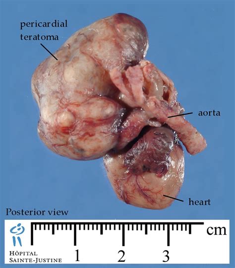 pericardial teratoma   Humpath.com   Human pathology