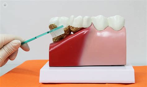 Periodontitis: cómo abordarla | odontólogo   Málaga