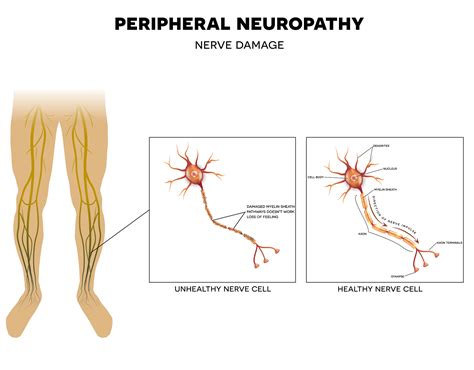 Peripheral Nerve Damage